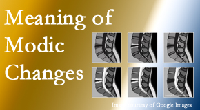 Rosenberg Wellness Center sees many back pain and neck pain patients who bring their MRIs with them to the office. Modic changes are often noted. 