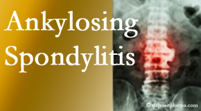 Ankylosing spondylitis is gently cared for by your New York City chiropractor.