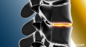 New York City degenerative spinal changes 