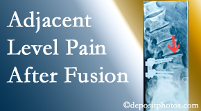 Rosenberg Wellness Center offers relieving care non-surgically to back pain patients experiencing adjacent level pain after spinal fusion surgery.