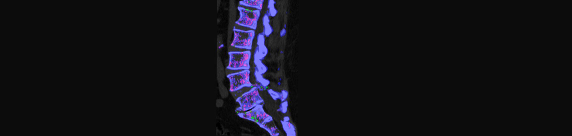 Rosenberg Wellness Center is aware that inflammatory spinal gout is a differential diagnosis to consider for patients who present with back pain and other spine related symptoms.