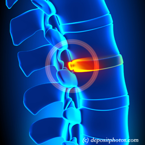 image of lumbar New York City disc herniation