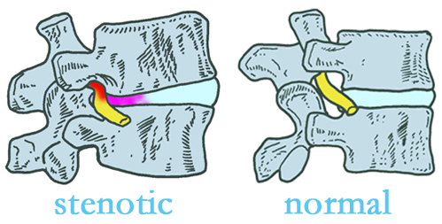 New York City stenotic and normal spinal discs